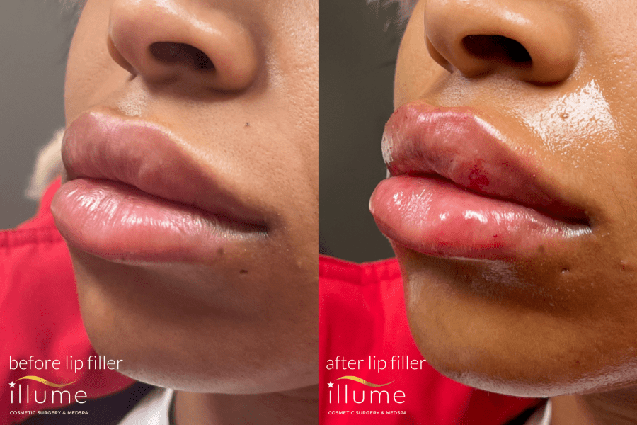 Beautiful transformation at Illume Cosmetic Surgery and Medspa in Wisconsin.
